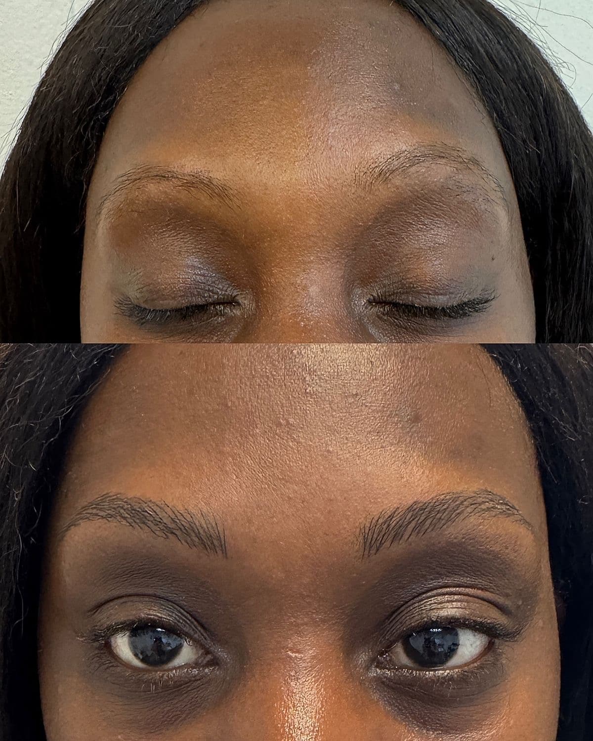 Browlift
