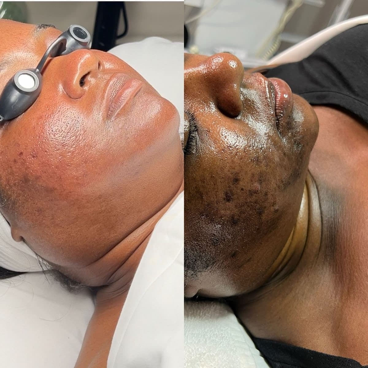 MICRO NEEDLING